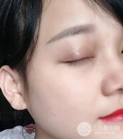 切开双眼皮术后改良双眼不对称，恢复果图分享