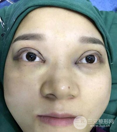 切开双眼皮术后改良双眼不对称，恢复果图分享