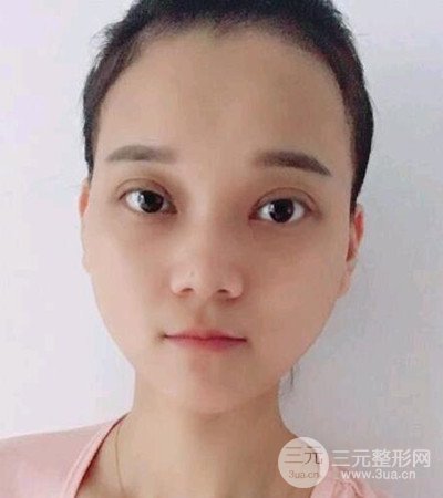 切开双眼皮术后改良双眼不对称，恢复果图分享