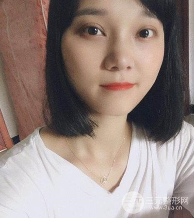 切开双眼皮术后改良双眼不对称，恢复果图分享