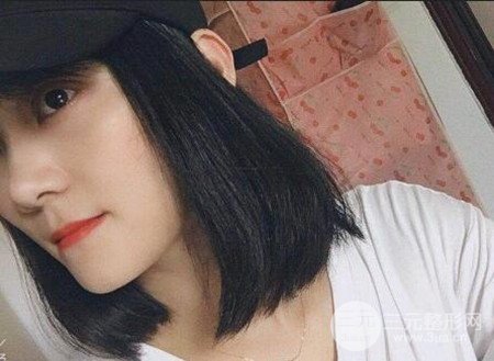 切开双眼皮术后改良双眼不对称，恢复果图分享