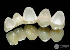 纯钛烤瓷牙的价格?多少钱?