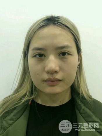 大圆脸做了面部吸脂瘦脸果很棒，立现漂亮鹅蛋脸