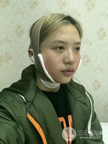 大圆脸做了面部吸脂瘦脸果很棒，立现漂亮鹅蛋脸