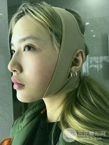 大圆脸做了面部吸脂瘦脸果很棒，立现漂亮鹅蛋脸