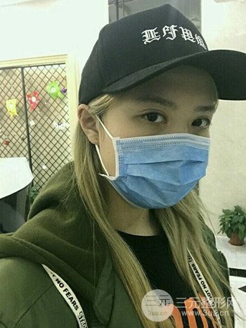 大圆脸做了面部吸脂瘦脸果很棒，立现漂亮鹅蛋脸