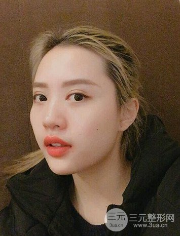 大圆脸做了面部吸脂瘦脸果很棒，立现漂亮鹅蛋脸