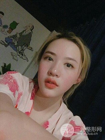 大圆脸做了面部吸脂瘦脸果很棒，立现漂亮鹅蛋脸