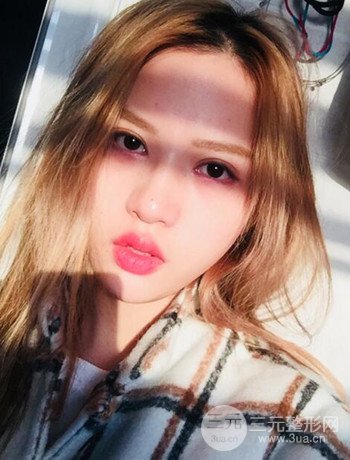 大圆脸做了面部吸脂瘦脸果很棒，立现漂亮鹅蛋脸