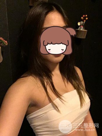 职业模特做了假体隆胸手术分享手术恢复照片