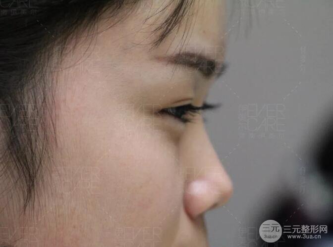 北京伊美尔徐军假体隆鼻前后对比照片心情日记
