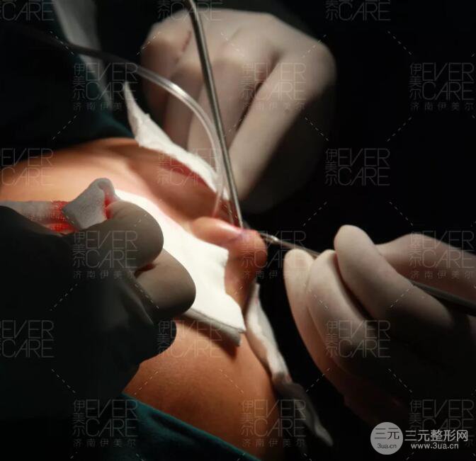 北京伊美尔徐军假体隆鼻前后对比照片心情日记