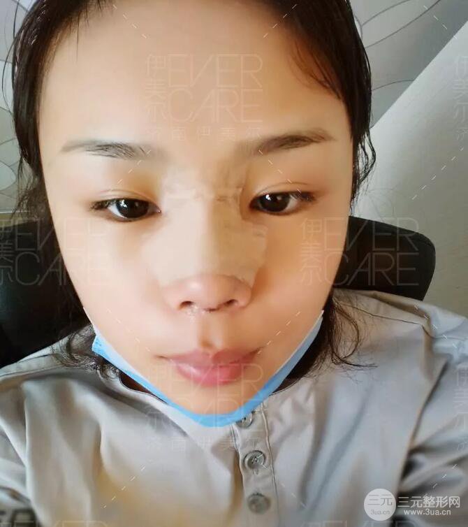 北京伊美尔徐军假体隆鼻前后对比照片心情日记
