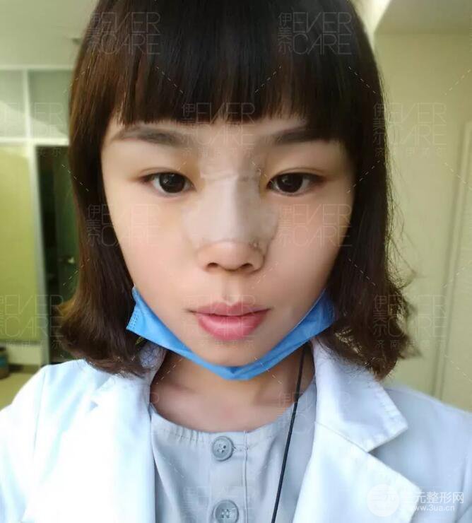 北京伊美尔徐军假体隆鼻前后对比照片心情日记