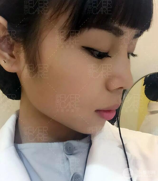 北京伊美尔徐军假体隆鼻前后对比照片心情日记