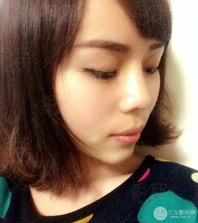 北京伊美尔徐军假体隆鼻前后对比照片心情日记