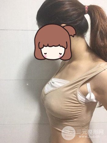 假体隆胸术后成功摆脱小学生身材，立现性感身材