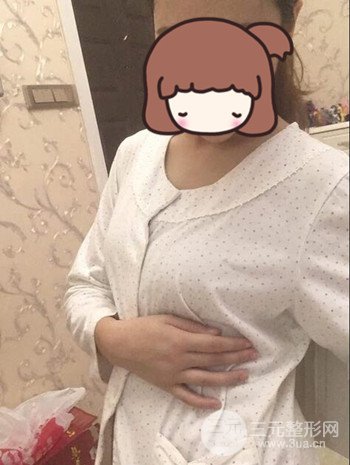 假体隆胸术后成功摆脱小学生身材，立现性感身材