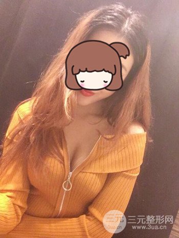 假体隆胸术后成功摆脱小学生身材，立现性感身材