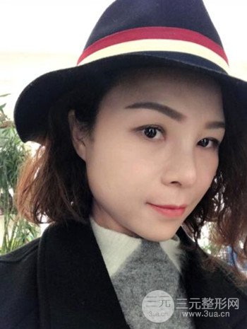 隆鼻整形手术真人案例恢复过程分享 附上果图