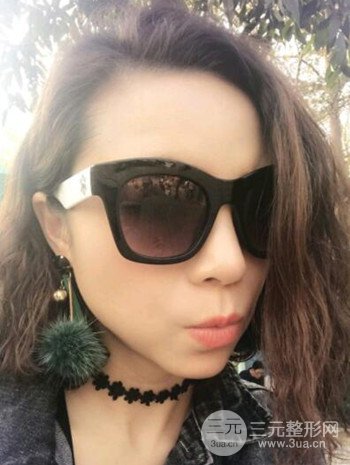 隆鼻整形手术真人案例恢复过程分享 附上果图