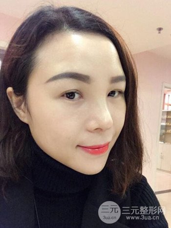 隆鼻整形手术真人案例恢复过程分享 附上果图