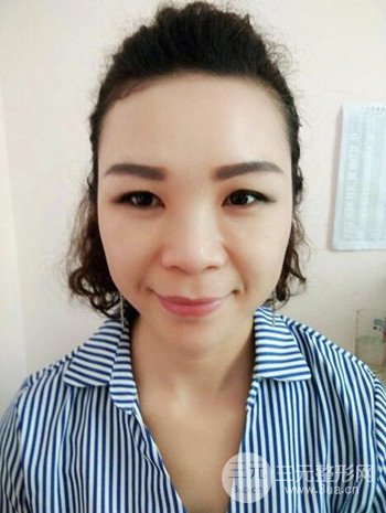 隆鼻整形手术真人案例恢复过程分享 附上果图