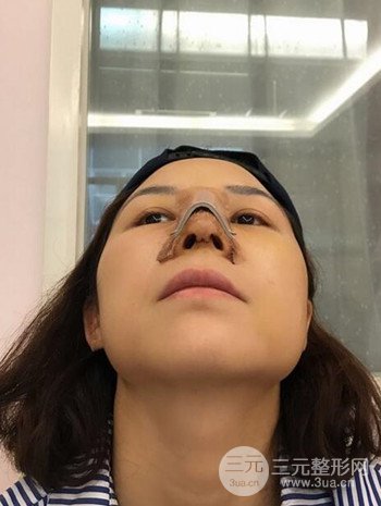 隆鼻整形手术真人案例恢复过程分享 附上果图