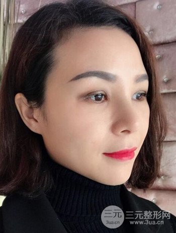 隆鼻整形手术真人案例恢复过程分享 附上果图