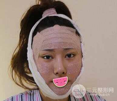 徐陇豫全脸脂肪填充前后对比照片见证美女翻身日记