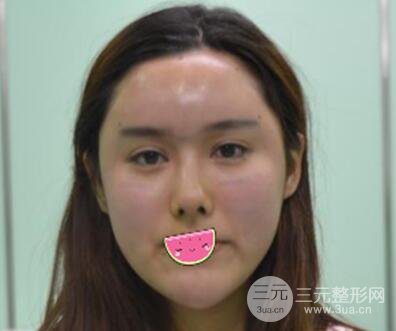 徐陇豫全脸脂肪填充前后对比照片见证美女翻身日记
