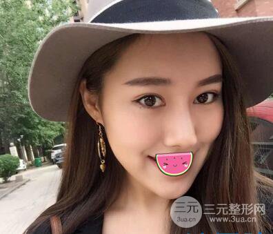 徐陇豫全脸脂肪填充前后对比照片见证美女翻身日记