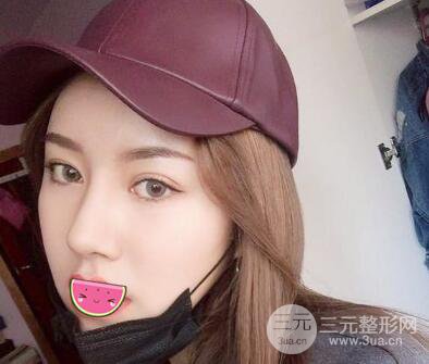徐陇豫全脸脂肪填充前后对比照片见证美女翻身日记