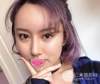 徐陇豫全脸脂肪填充前后对比照片见证美女翻身日记