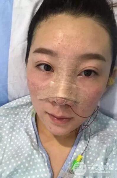 北京伊美尔徐军隆鼻整形前后对比照片心情记录小札