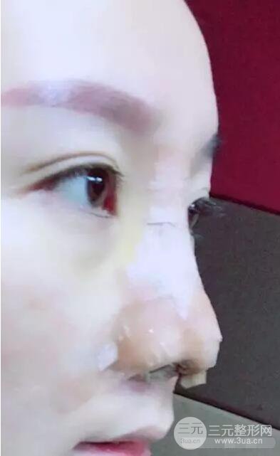 北京伊美尔徐军隆鼻整形前后对比照片心情记录小札