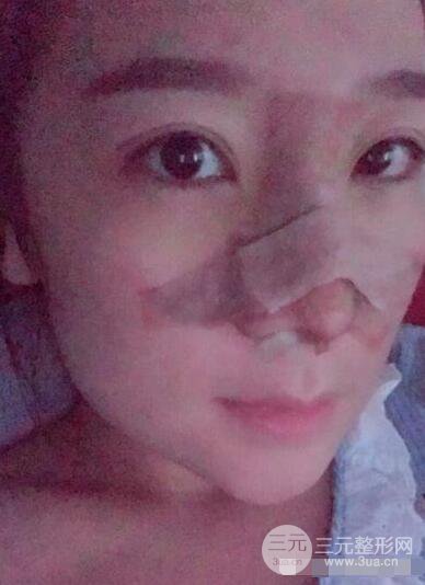 北京伊美尔徐军隆鼻整形前后对比照片心情记录小札