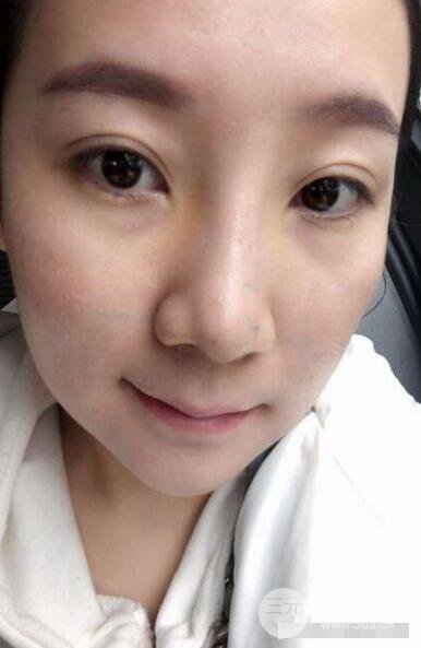北京伊美尔徐军隆鼻整形前后对比照片心情记录小札