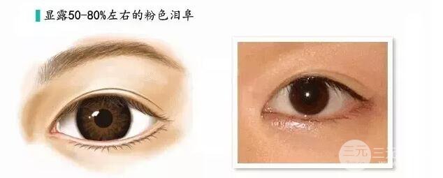 重庆万州华美双眼皮+内眼角