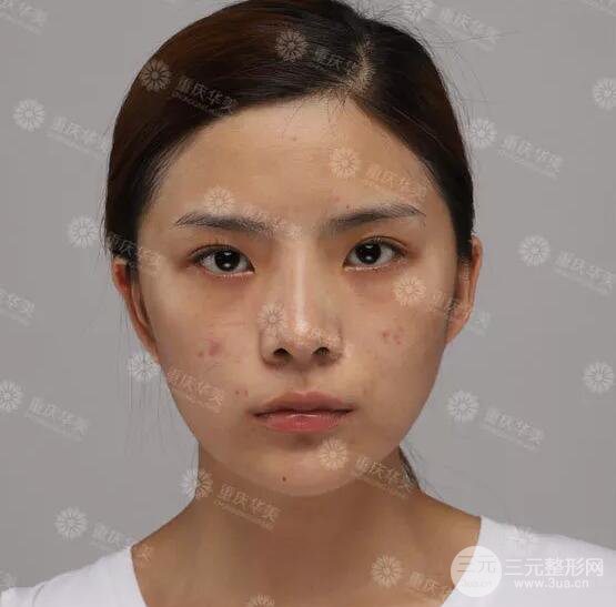 重庆万州华美双眼皮+内眼角