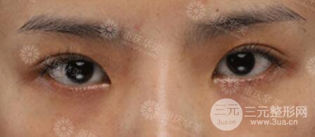 重庆万州华美双眼皮+内眼角