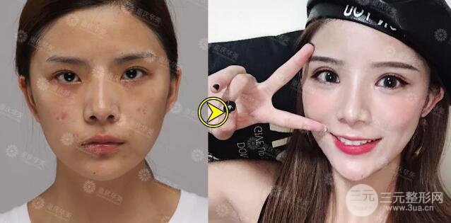 重庆万州华美双眼皮+内眼角