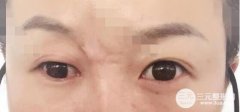 注射微j瓷隆鼻多少钱？果能坚持多久？