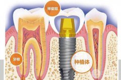 种植牙的利与弊