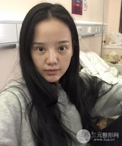 做了隆鼻整形成功落实精致小巧鼻 附上果图