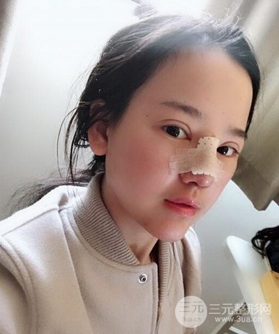 做了隆鼻整形成功落实精致小巧鼻 附上果图