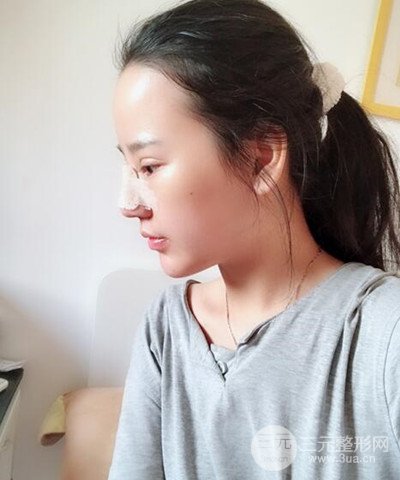 做了隆鼻整形成功落实精致小巧鼻 附上果图