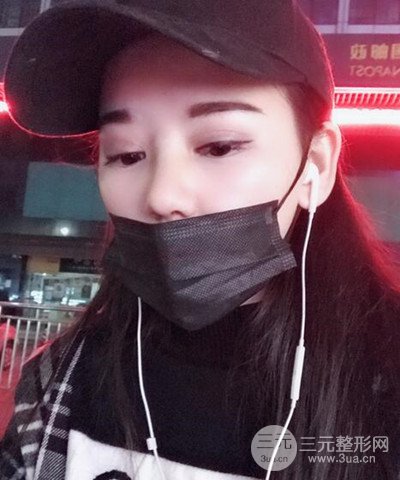 做了隆鼻整形成功落实精致小巧鼻 附上果图