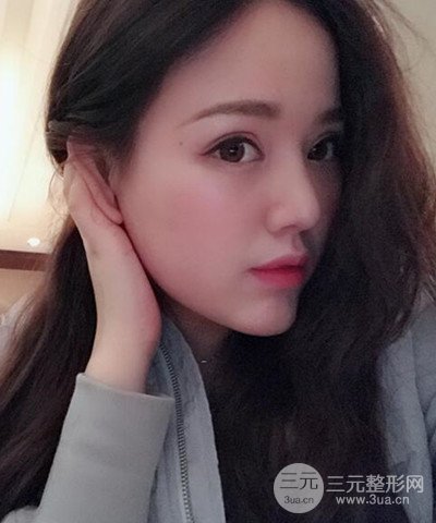 做了隆鼻整形成功落实精致小巧鼻 附上果图