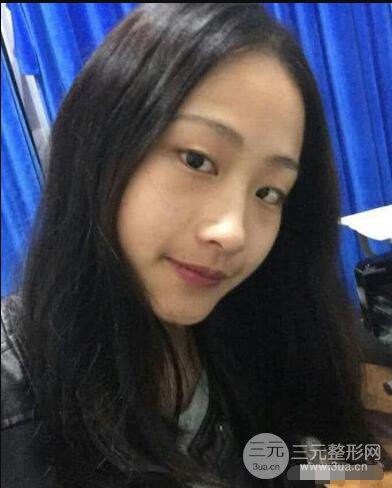 常州二院整形科李新庆割双眼皮前后对比图 单眼皮变身双眼皮大眼睛
